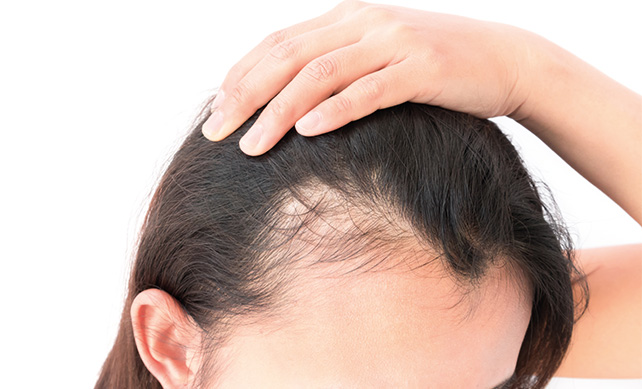 Women-Hair-Transplant hair promed