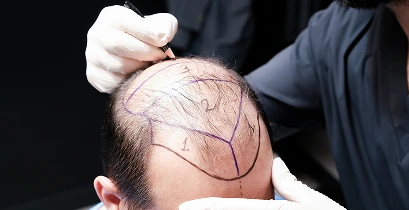 esteloom hair transplant