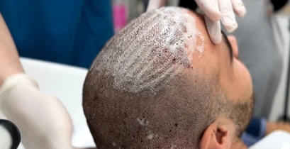 esteloom hair transplant