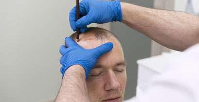 esteloom hair transplant