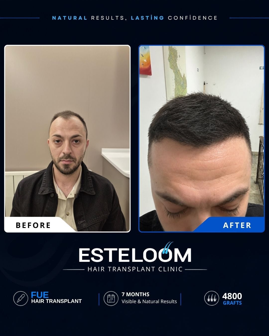 Hair transplant before and after result 1
