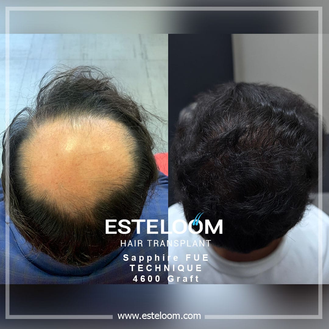 Hair transplant before and after result 2