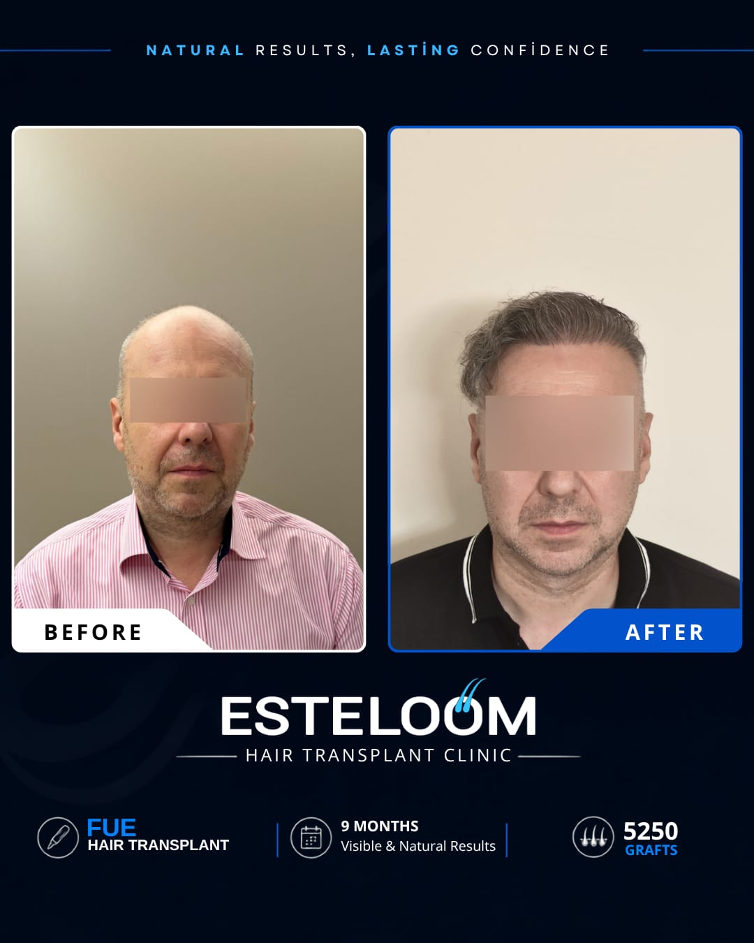 Hair transplant before and after result 3