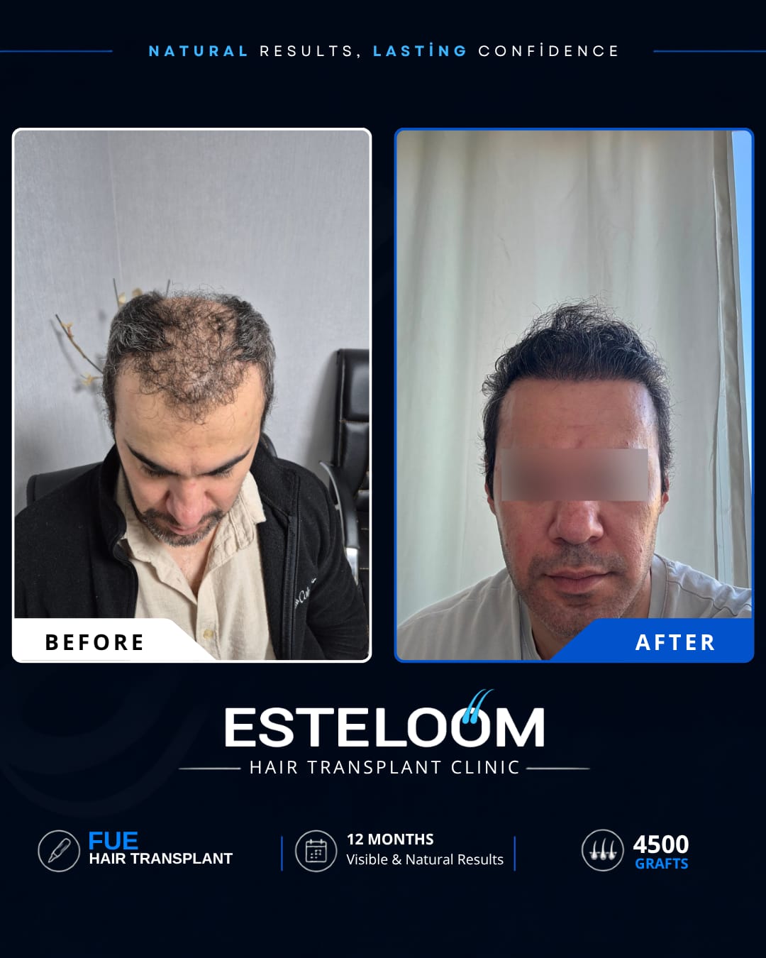Hair transplant before and after result 4