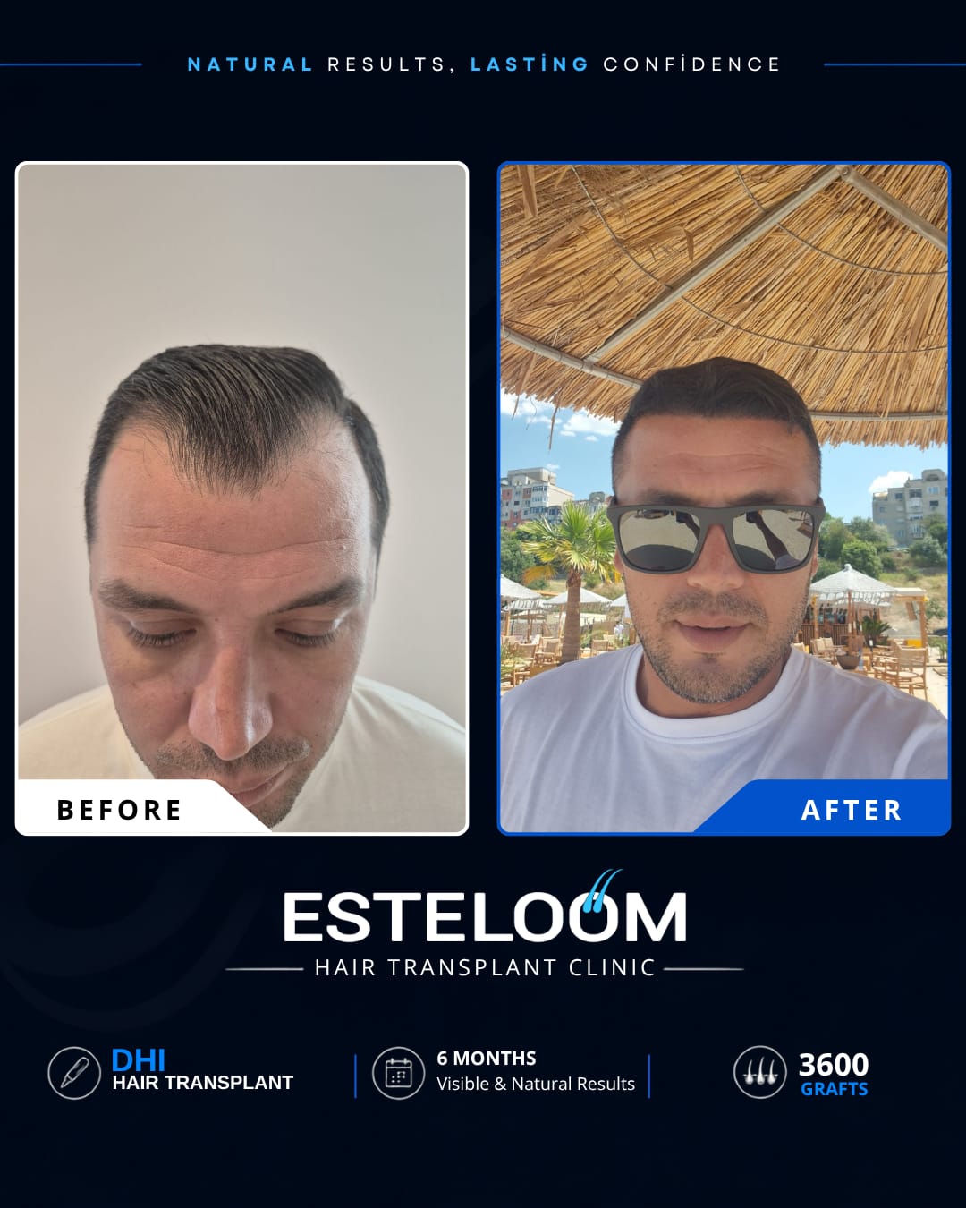 Hair transplant before and after result 5