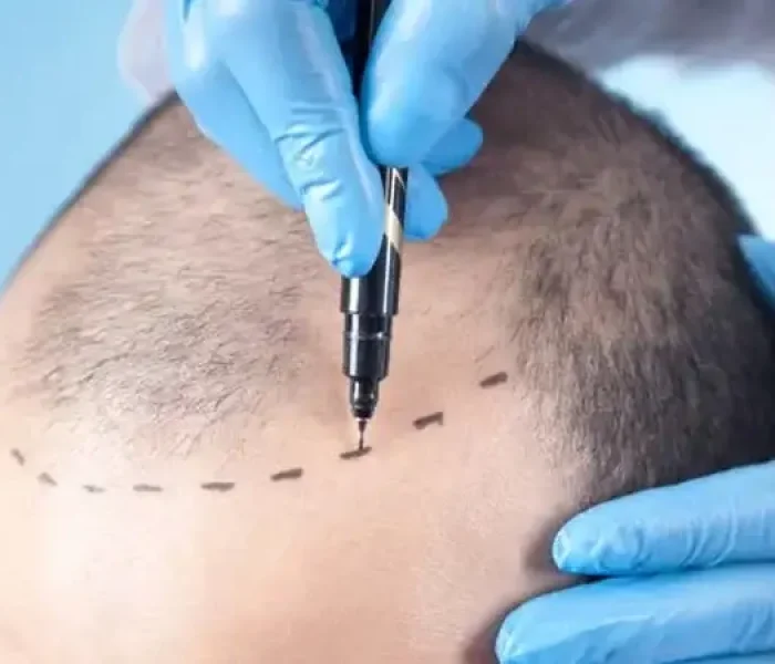 What-Is-a-Fue-Hair-Transplant What-Is-a-Fue-Hair-Transplant